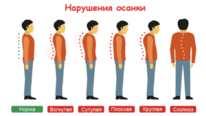 Лечение нарушений осанки в Кременчуге