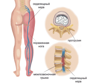 Лечение ишиаса в Кременчуге