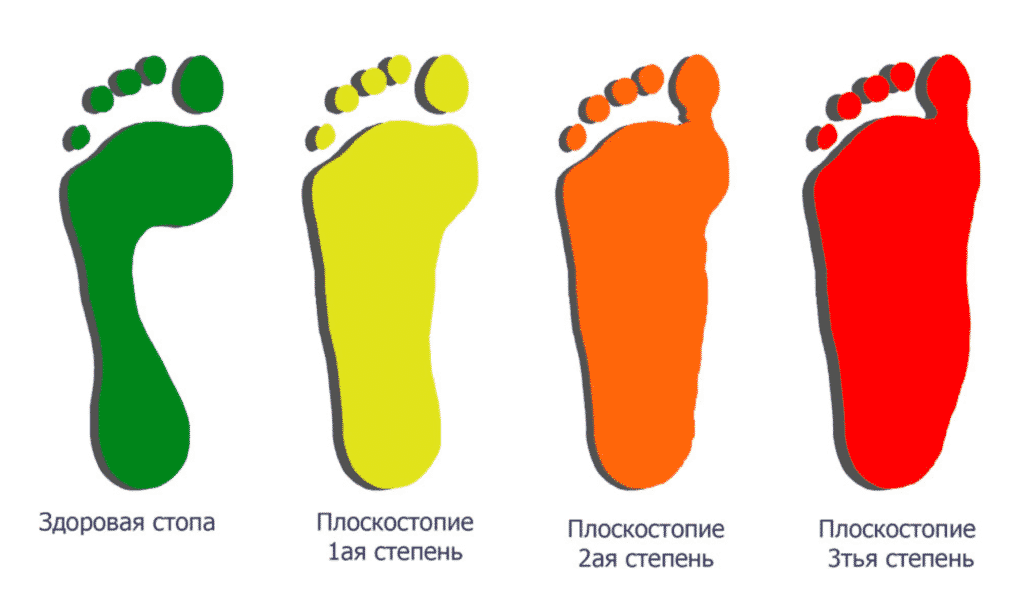 Лечение плоскостопия в Кременчуге