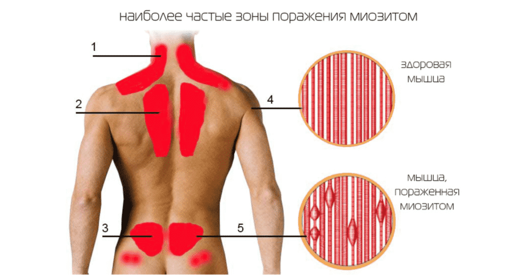 Лечение миозита в Кременчуге
