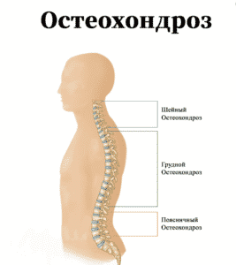 Лечение остеохондроза в Кременчуге