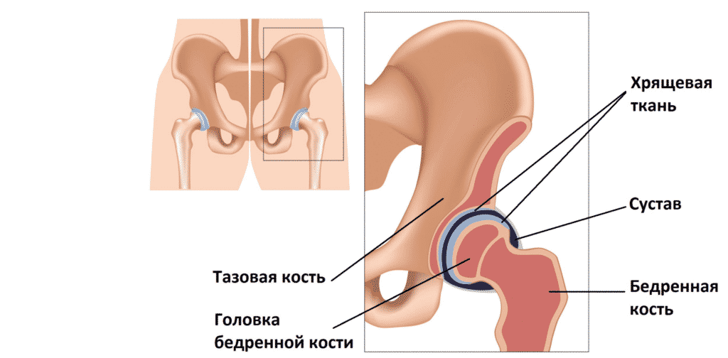 Лечение боли в тазобедренном суставе