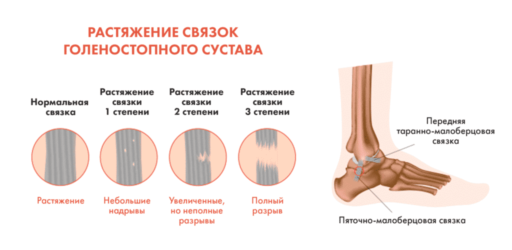 Лечение ушибов в Кременчуге