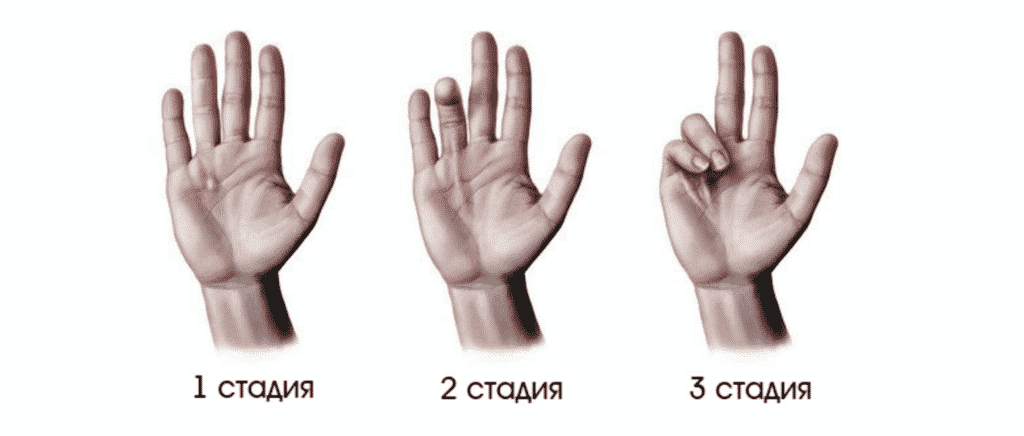 Лечение контрактуры в Кременчуге
