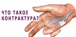 Лечение контрактуры в Кременчуге