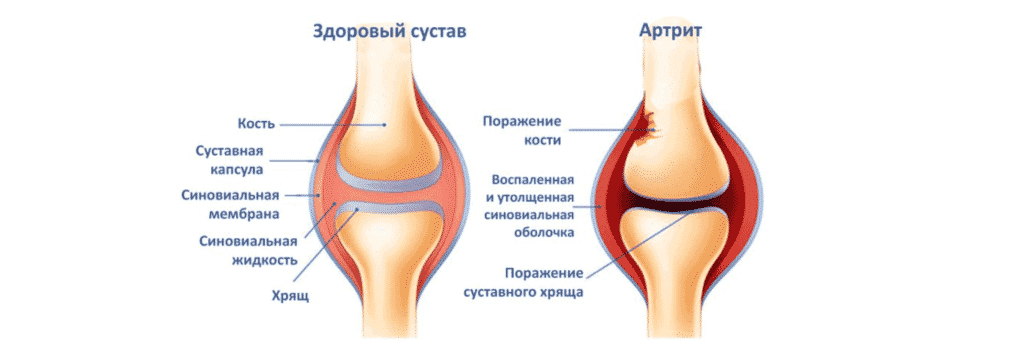 Лечение боли в колене в Кременчуге