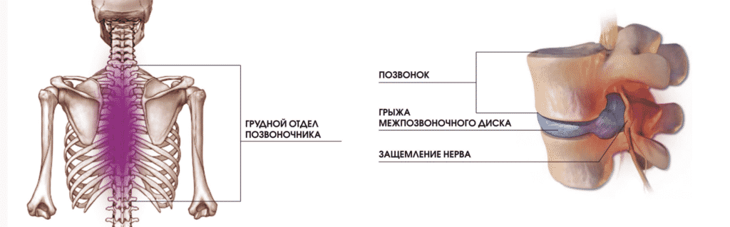 Лечение боли в грудном отделе в Кременчуге