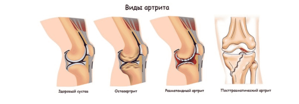 Лечение артрита в Кременчуге