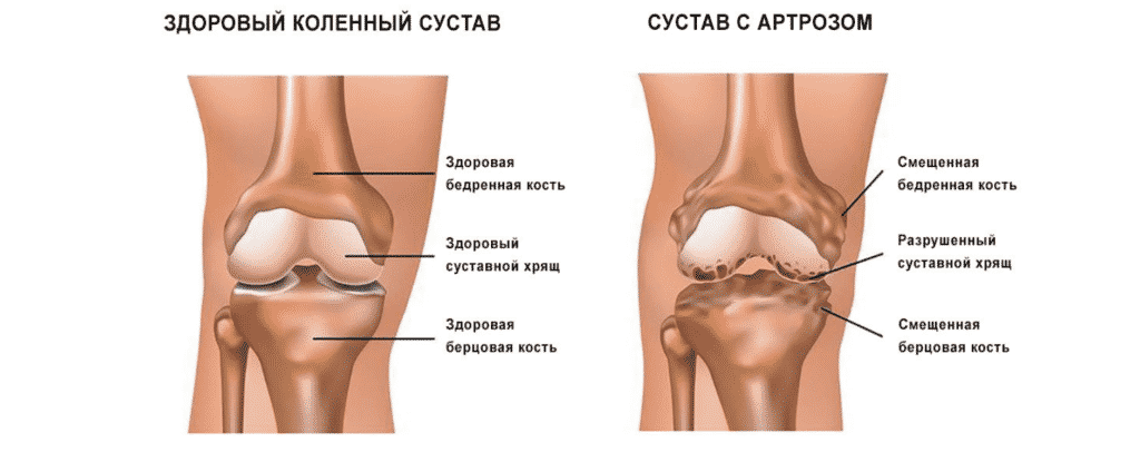 Лечение артроза в Кременчуге