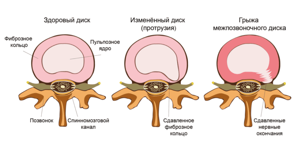 Лечение корешкового синдрома в Кременчуге